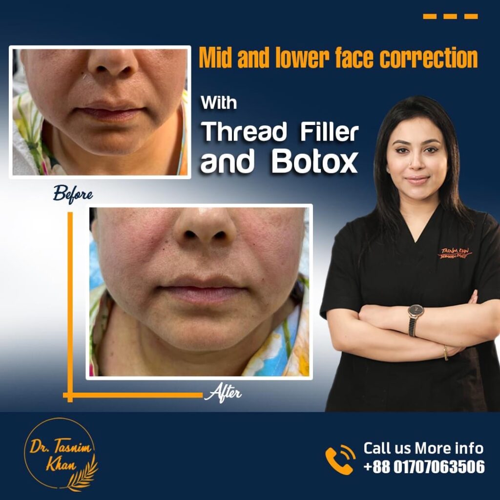 Thread, Filler & Botox